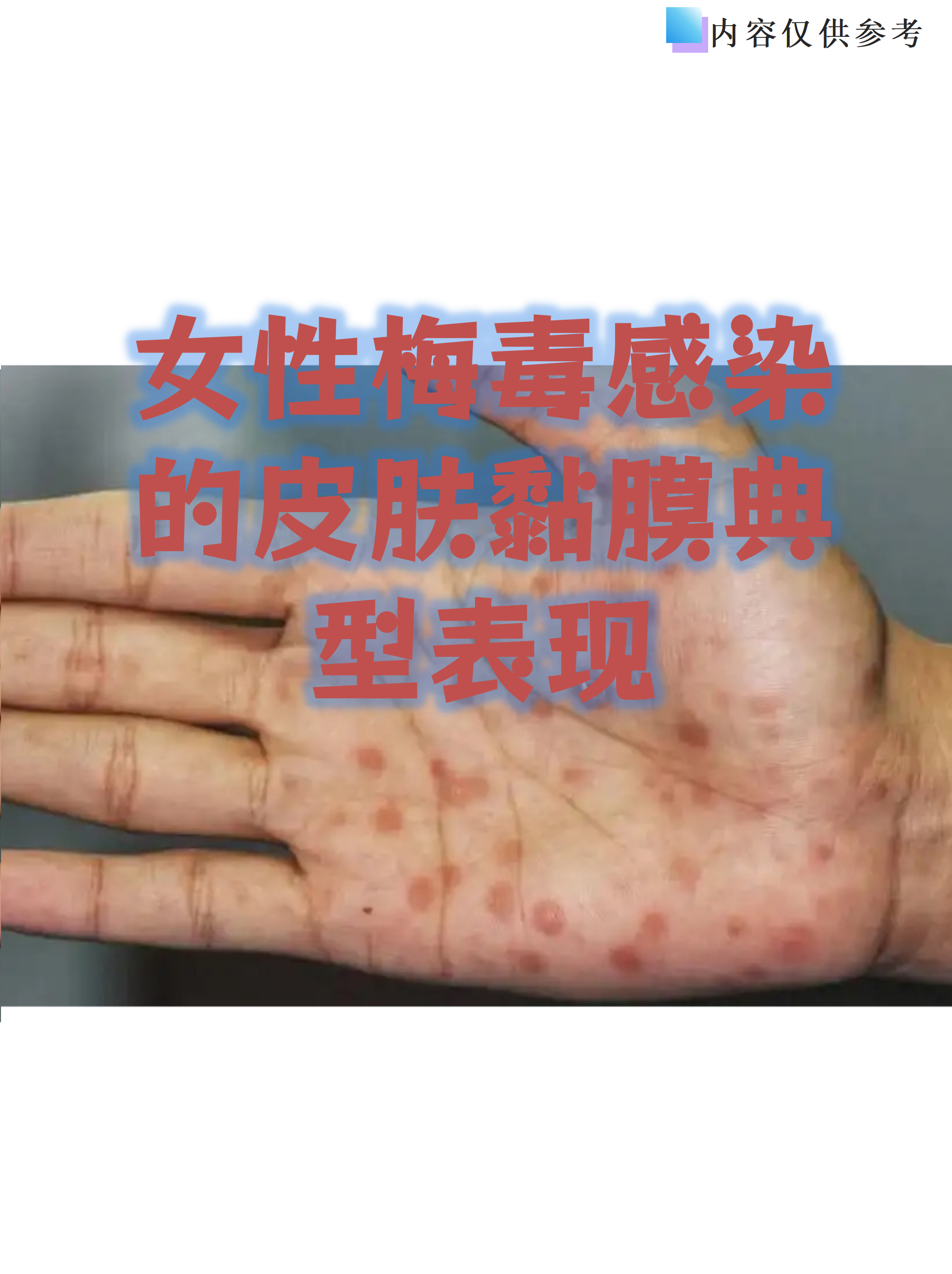 梅毒女性早期症状图片(梅毒女性早期图片大全 初期) 梅毒女性早期症状图片(梅毒女性早期图片大全 初期)
