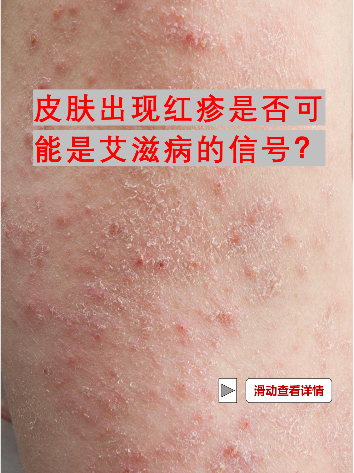 艾滋病胸前红疹图片(艾滋病胸前红疹子和普通疹子区别) 艾滋病胸前红疹图片(艾滋病胸前红疹子和普通疹子区别)