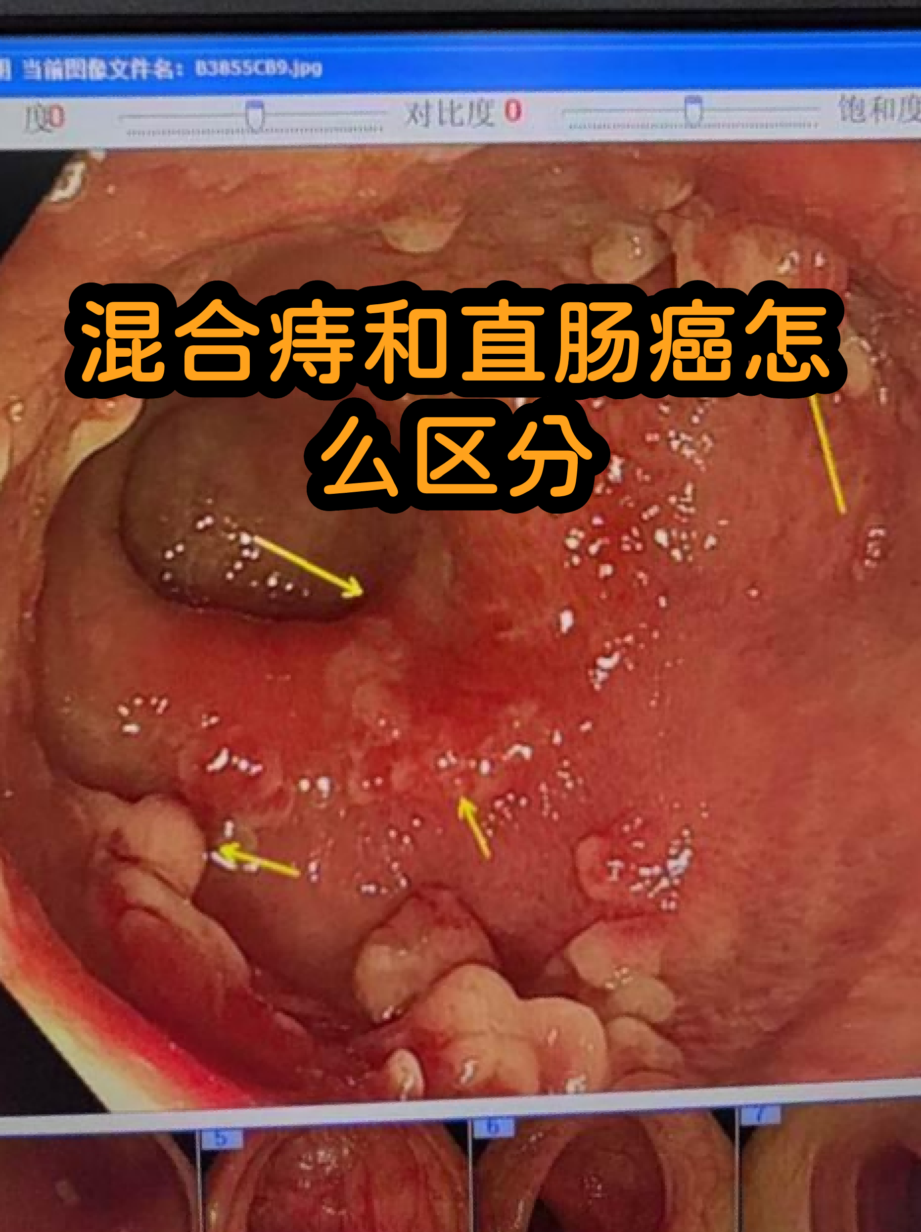 肛门癌真实图片(肛门癌的症状图片揭示)