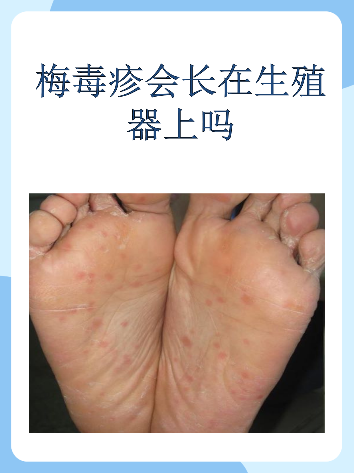 下疳是什么意思(皮肤出现硬下疳是什么意思)