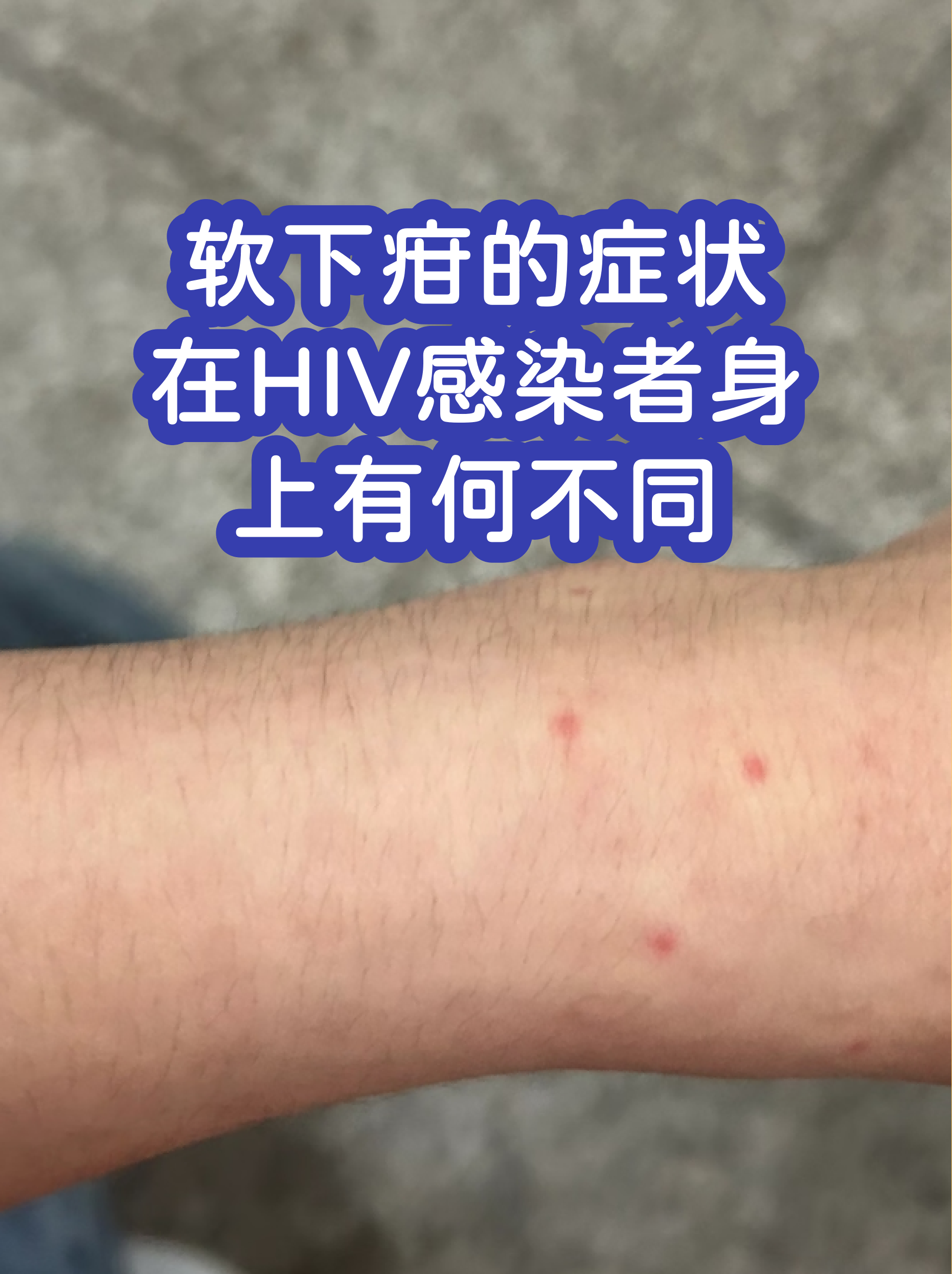 下疳是什么意思(皮肤出现硬下疳是什么意思) 下疳是什么意思(皮肤出现硬下疳是什么意思)