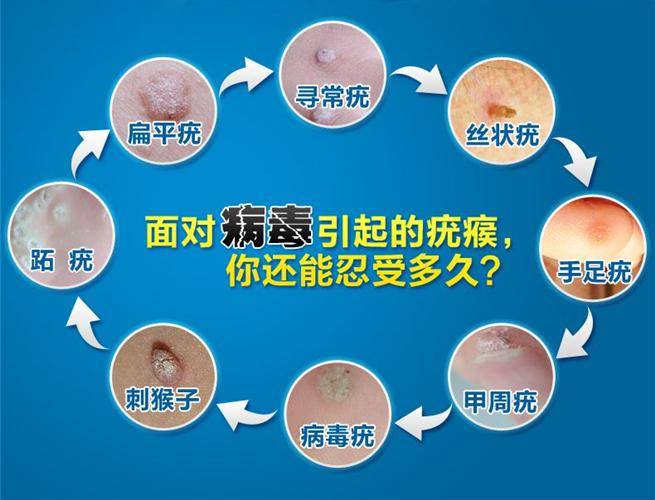 男性生殖器上疣图片(尖锐刚开始长出来的样子) 男性生殖器上疣图片(尖锐刚开始长出来的样子)