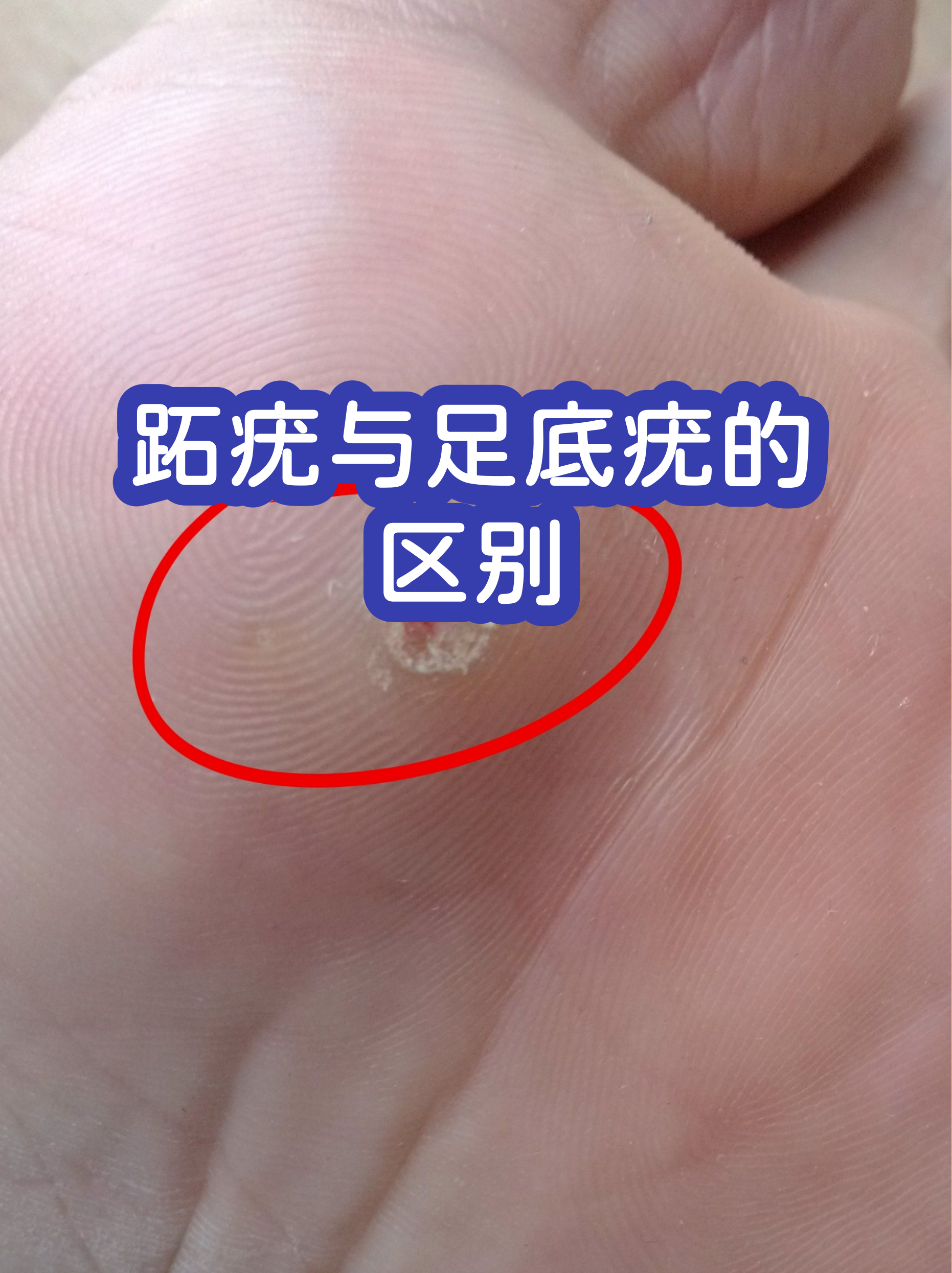 疣和瘊子的区别图片(疣和瘊子的区别图片黑色) 疣和瘊子的区别图片(疣和瘊子的区别图片黑色)