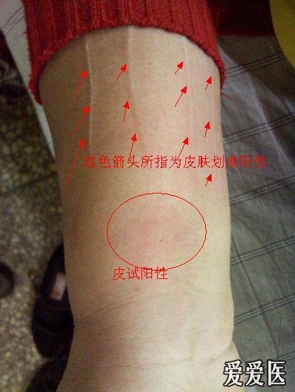 头孢皮试过敏症状(头孢皮试过敏会出现什么症状)