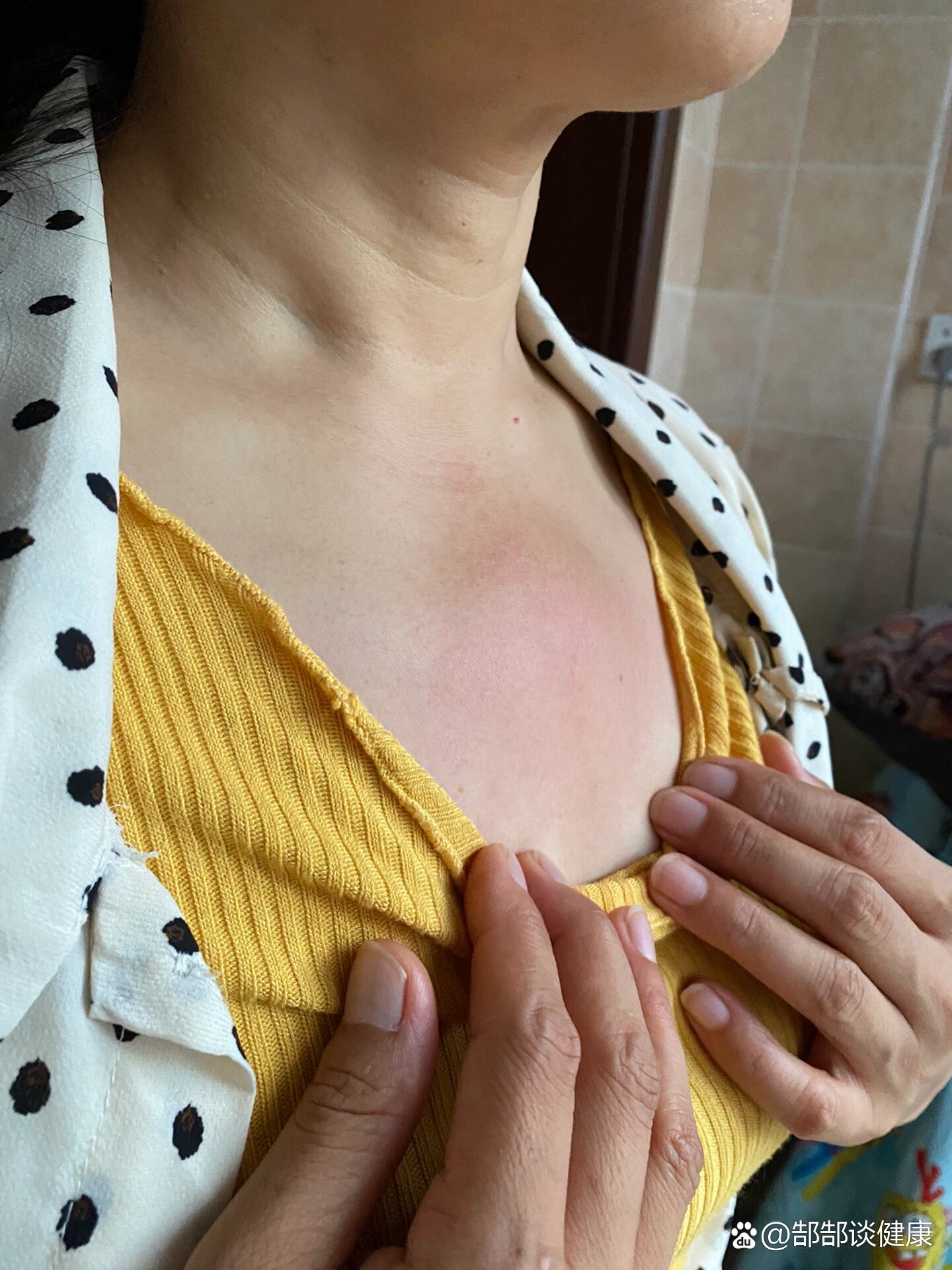 乳腺癌早期肿块图片图(乳腺癌早期症状的肿块按着会疼吗)