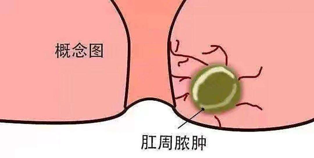 肛瘘术后40天恢复图片(肛瘘术后40天了还用换药吗)