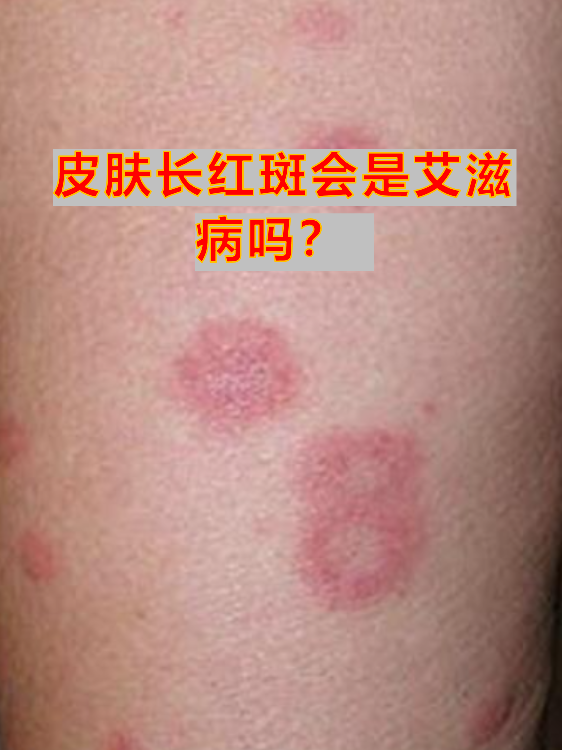 艾滋病红斑图片(艾滋病红斑图片早期症状图片)