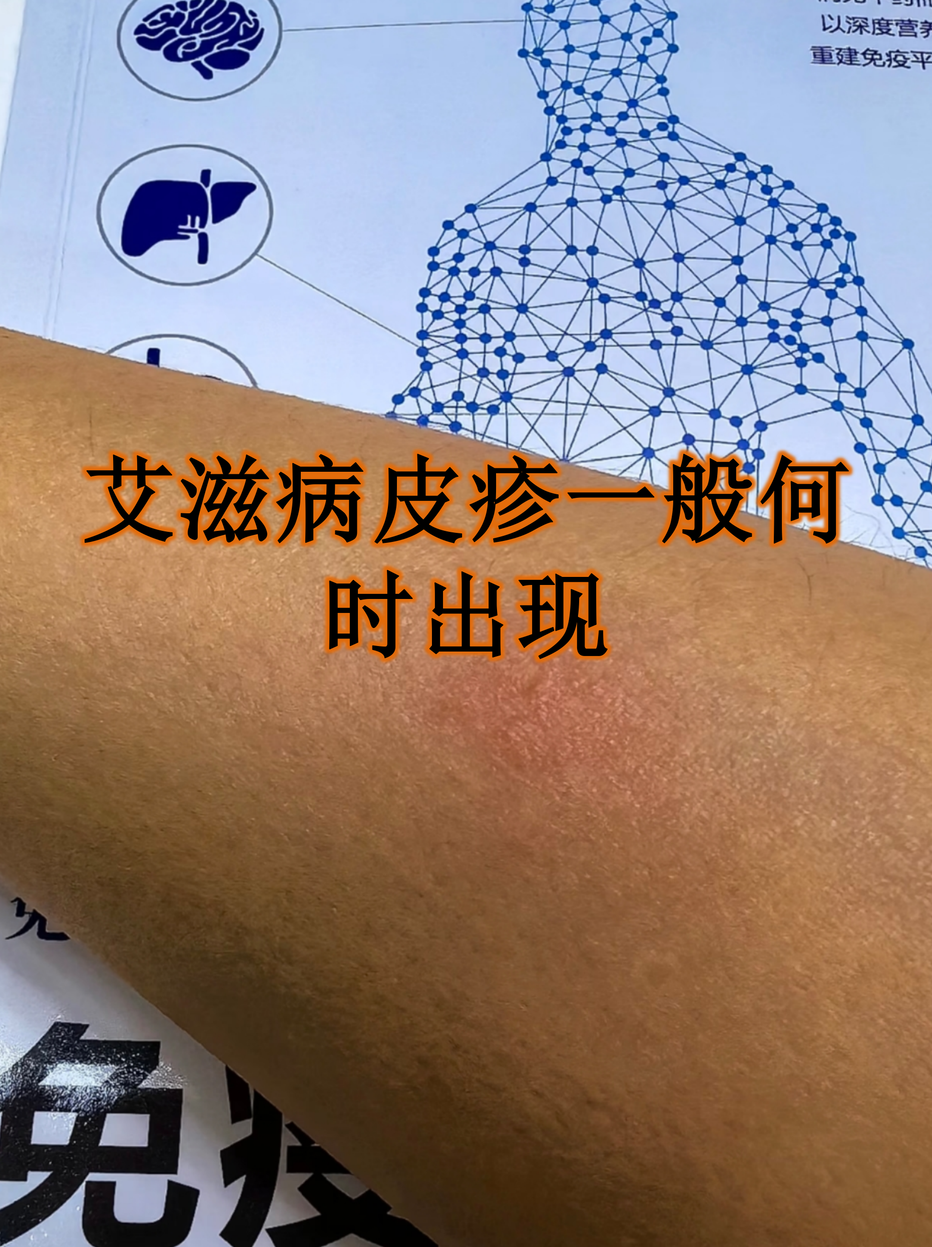 艾滋病起红疹子图片(艾滋病起红疹子图片大全)