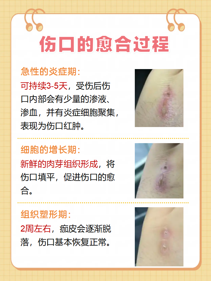 烫伤肉上有白色覆盖物(烫伤肉上有白色覆盖物是不是发炎)