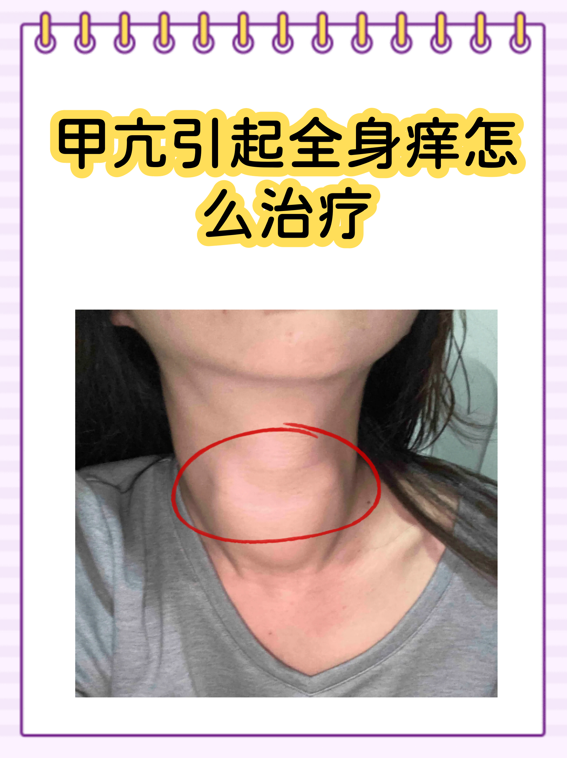 甲亢早期脖子图片(甲亢好了后脖子会恢复吗)