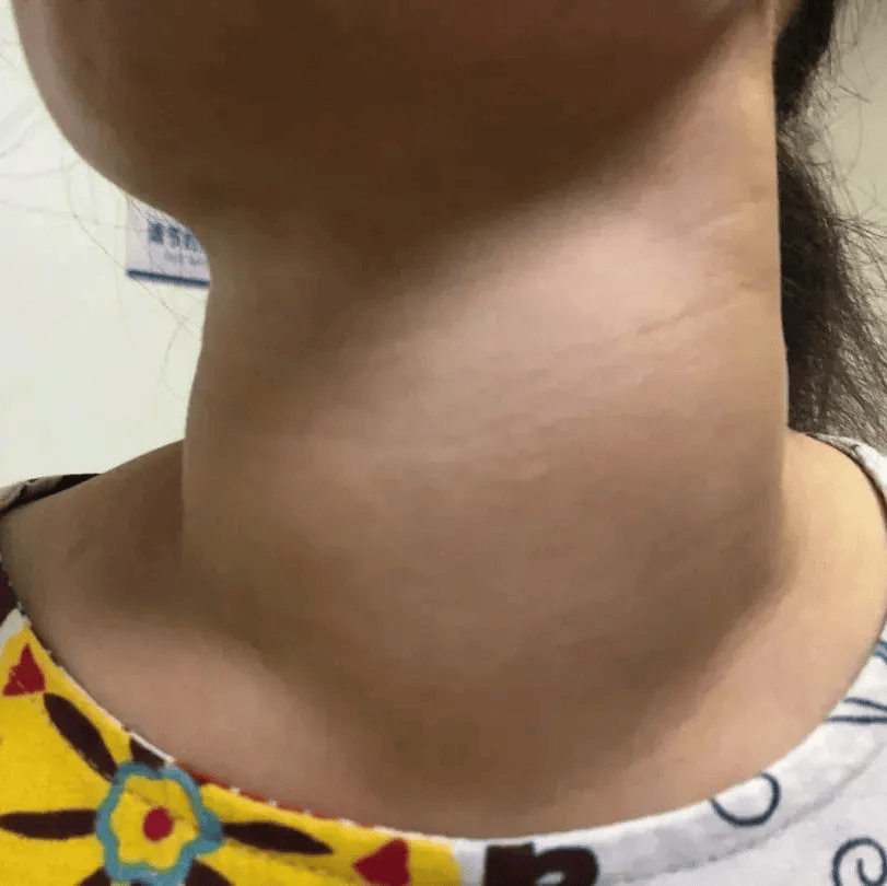 甲亢早期脖子图片(甲亢好了后脖子会恢复吗)