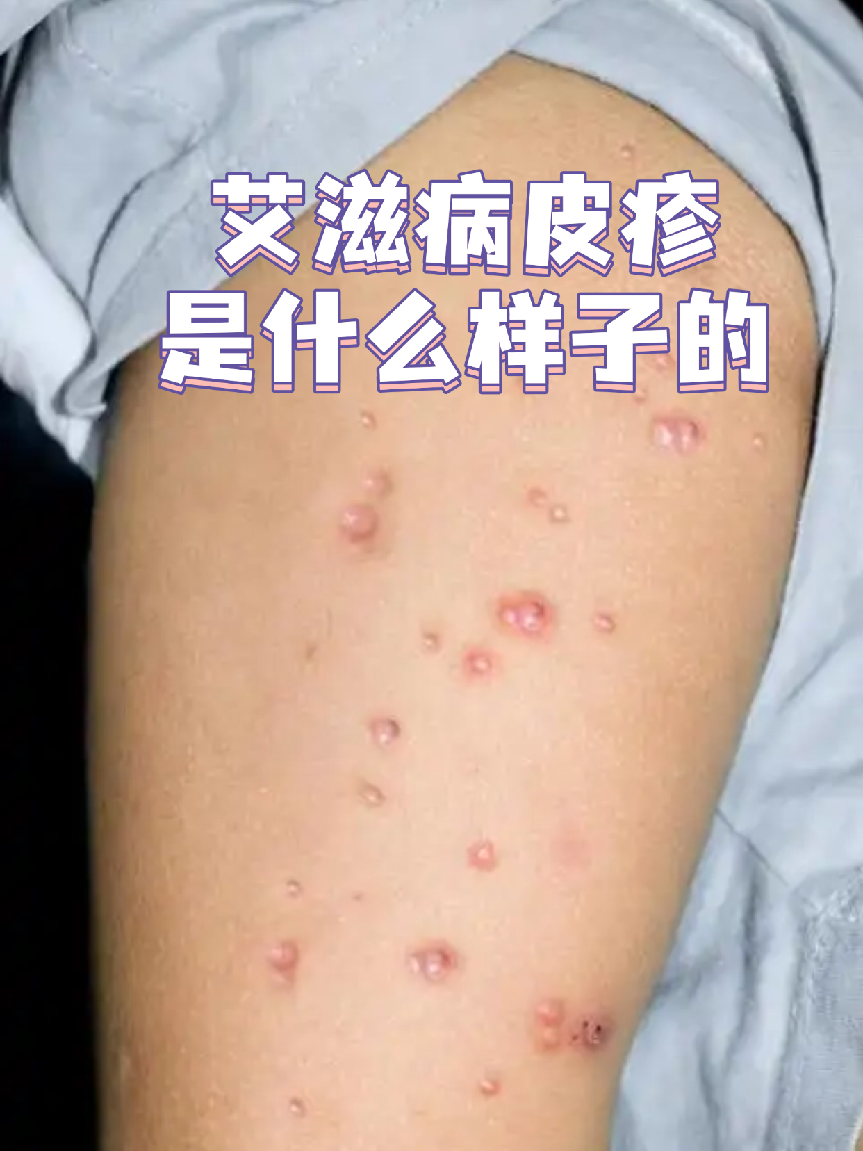 艾滋病皮肤瘙痒图片(艾滋病皮肤痒图 初期)