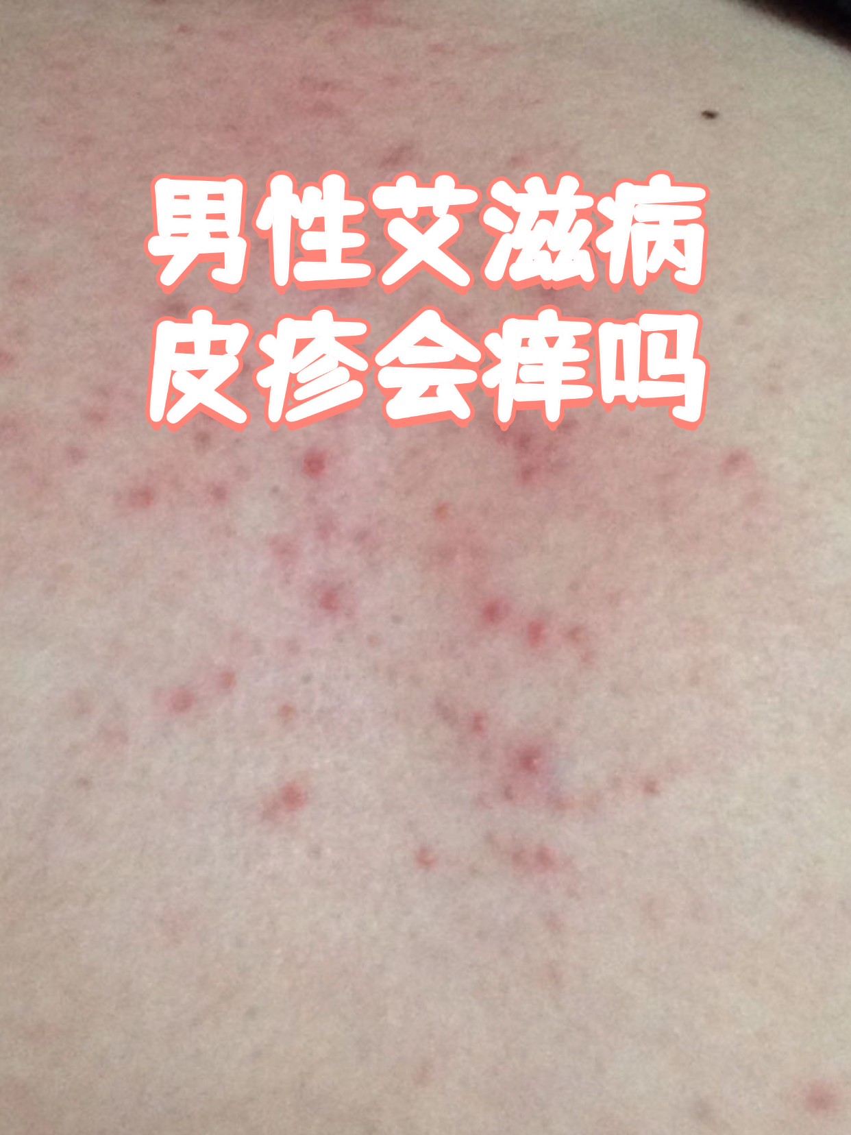 艾滋病皮肤瘙痒图片(艾滋病皮肤痒图 初期) 艾滋病皮肤瘙痒图片(艾滋病皮肤痒图 初期)