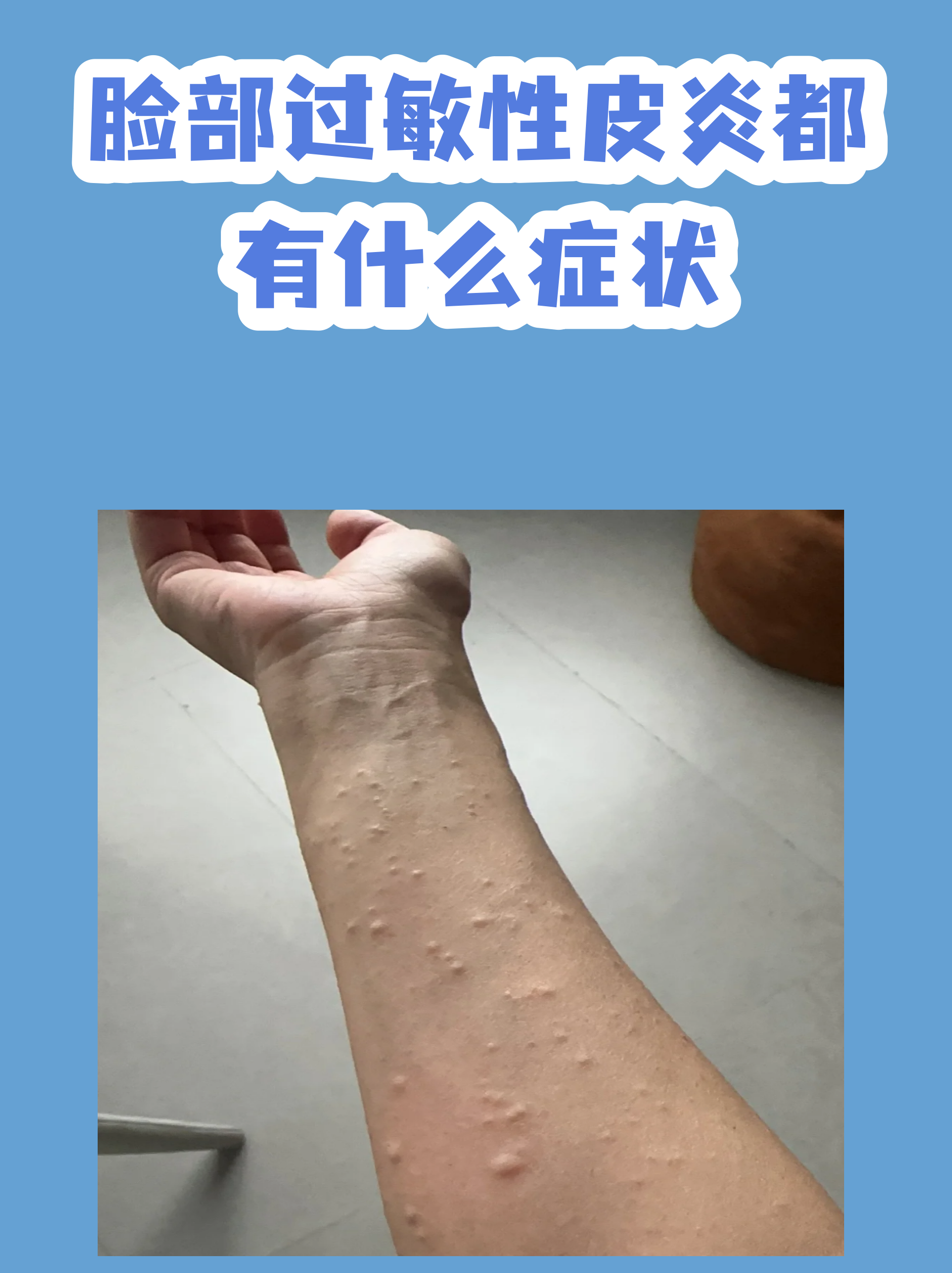 油漆过敏的症状图片(皮肤油漆过敏症状照片)