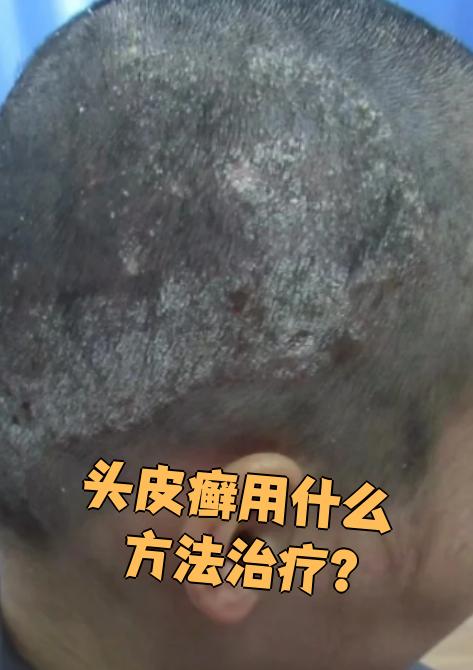 头皮癣图片(头皮癣图片脂溢性皮炎)