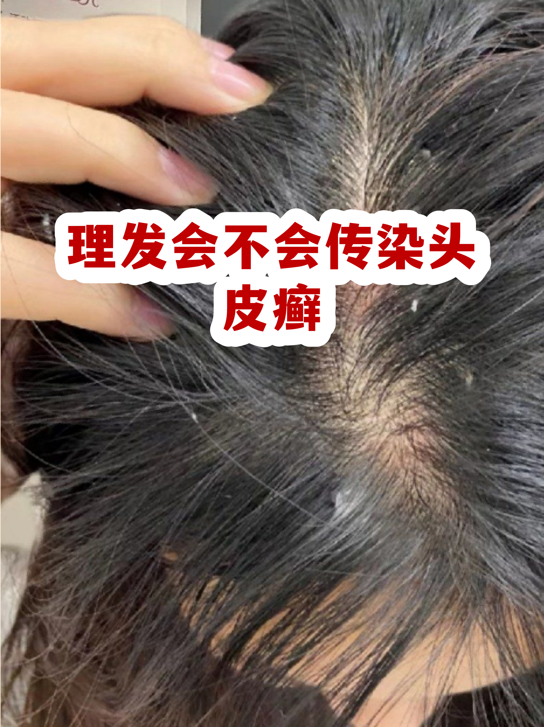 头皮癣图片(头皮癣图片脂溢性皮炎) 头皮癣图片(头皮癣图片脂溢性皮炎)