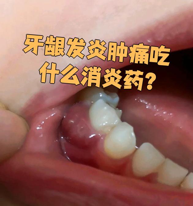 牙龈肿痛图片(牙龈肿痛图片大全图解上下)