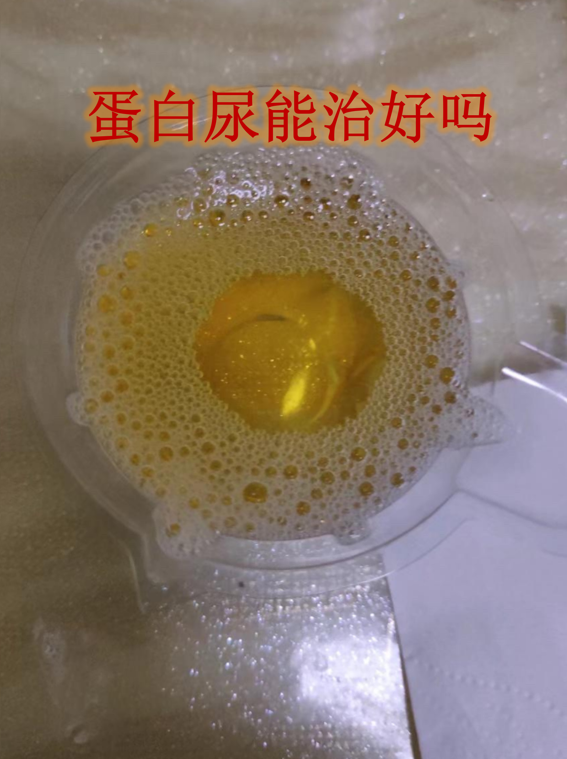 真正的尿蛋白图片(真正的尿蛋白图片 泡沫尿) 真正的尿蛋白图片(真正的尿蛋白图片 泡沫尿)