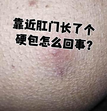 肛门蛲虫病的症状图片(肛门蛲虫病怎么治疗方法) 肛门蛲虫病的症状图片(肛门蛲虫病怎么治疗方法)