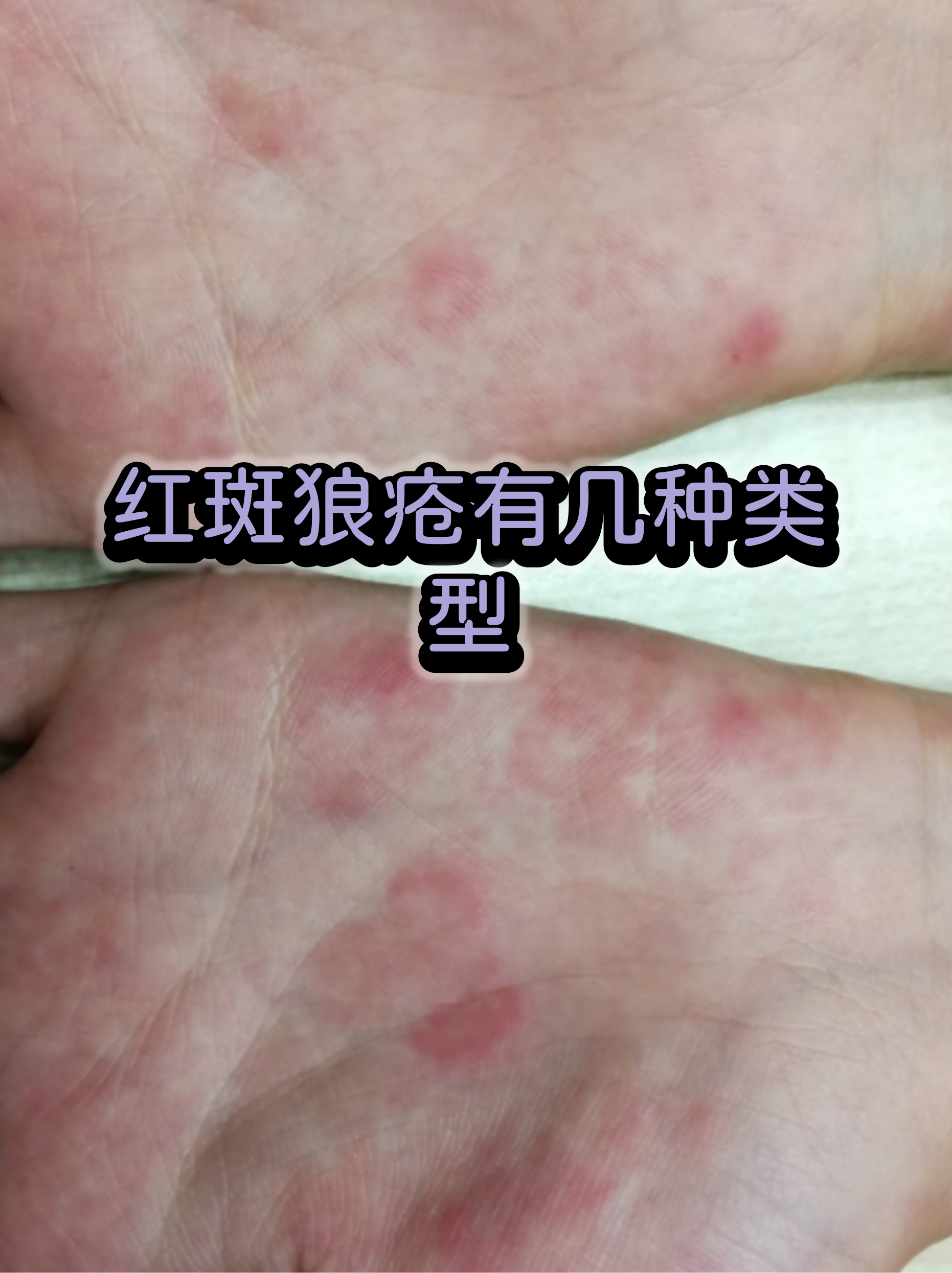 红斑图片(龟 头上红斑图片) 红斑图片(龟 头上红斑图片)