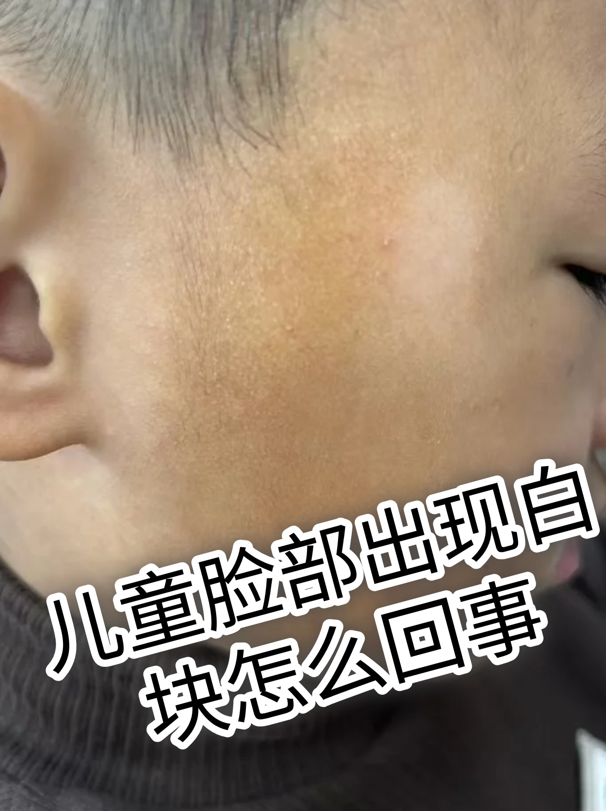 白色糠疹的图片(白色糠疹的图片会扩大吗)