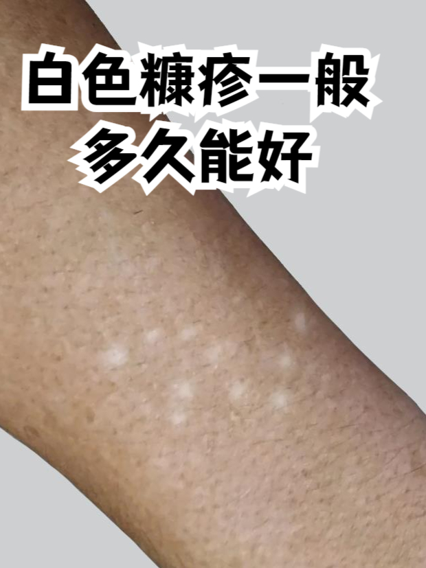 白色糠疹的图片(白色糠疹的图片会扩大吗) 白色糠疹的图片(白色糠疹的图片会扩大吗)