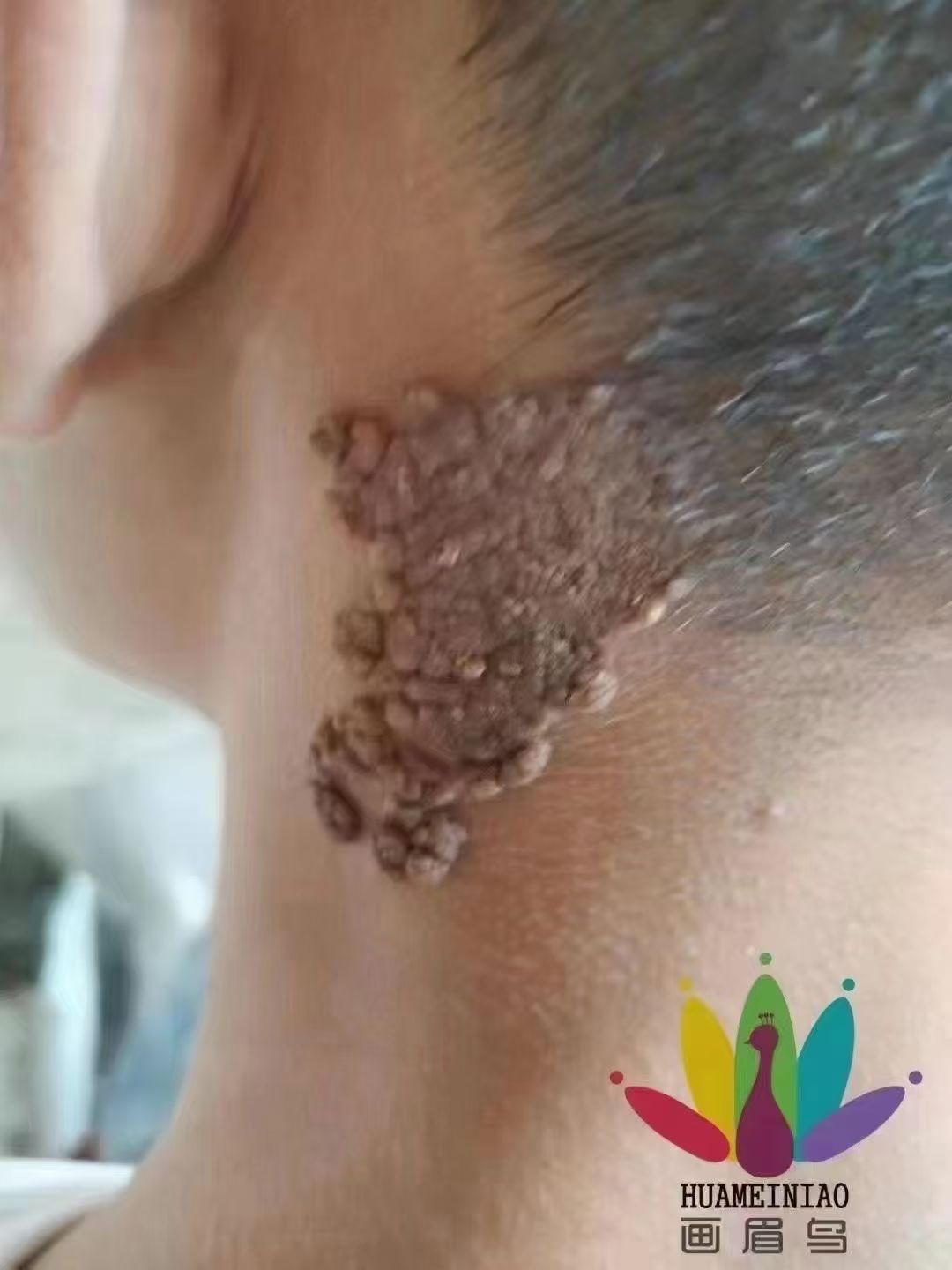 关于瘊子是什么皮肤病图片的信息 关于瘊子是什么皮肤病图片的信息