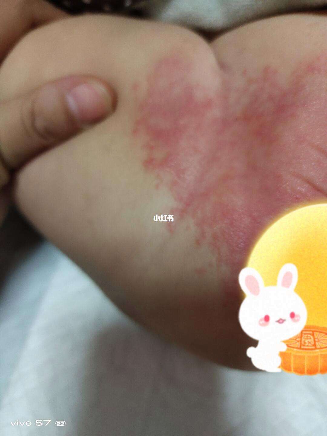 宝宝穿纸尿裤过敏的图片大全(宝宝穿纸尿裤过敏的图片大全真实)