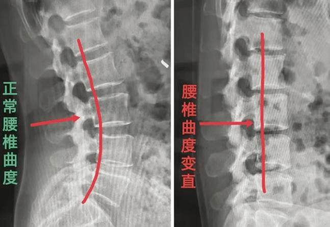 腰椎图片构造图解(颈椎腰椎图片构造图解) 腰椎图片构造图解(颈椎腰椎图片构造图解)