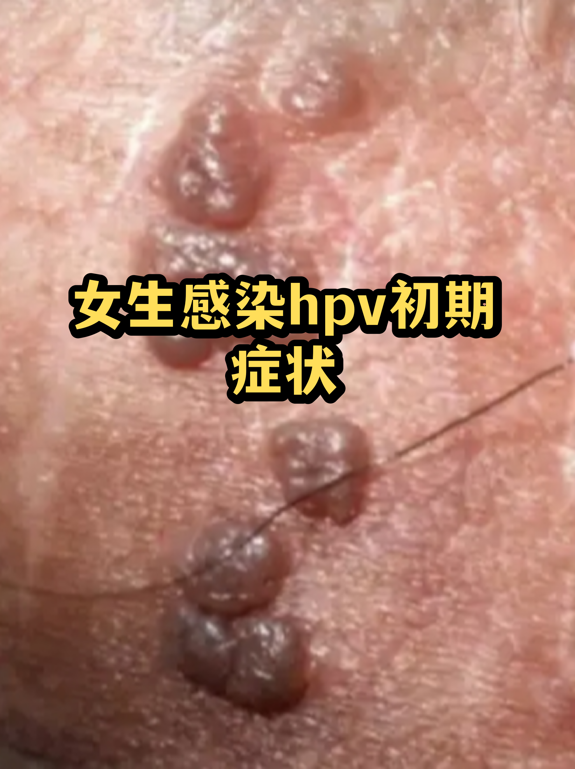 女性hpv初期感染的图片(女性hpv初期感染的图片私处)