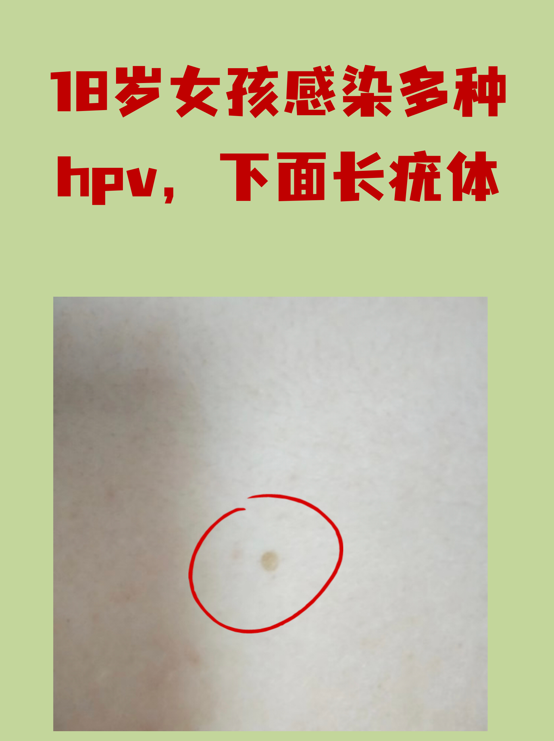 疣体初期图片(疣体一般长什么样子) 疣体初期图片(疣体一般长什么样子)