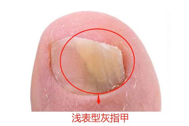 灰指甲的早期症状图(灰指甲早期症状图初始)
