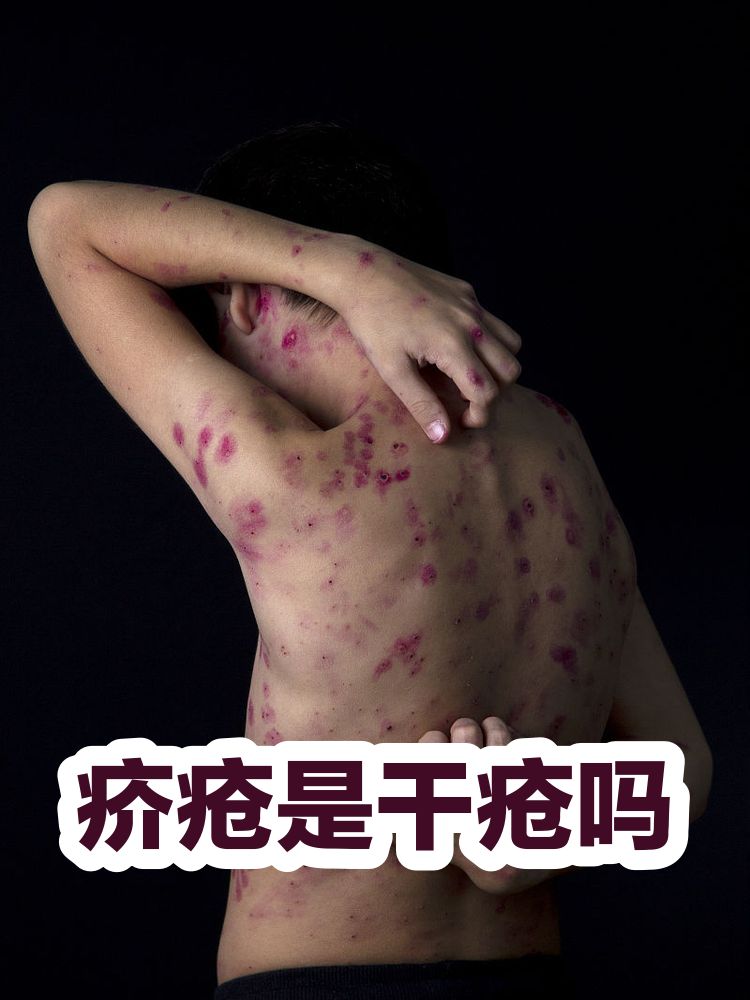 干疮图片(干疮图片和症状图片)