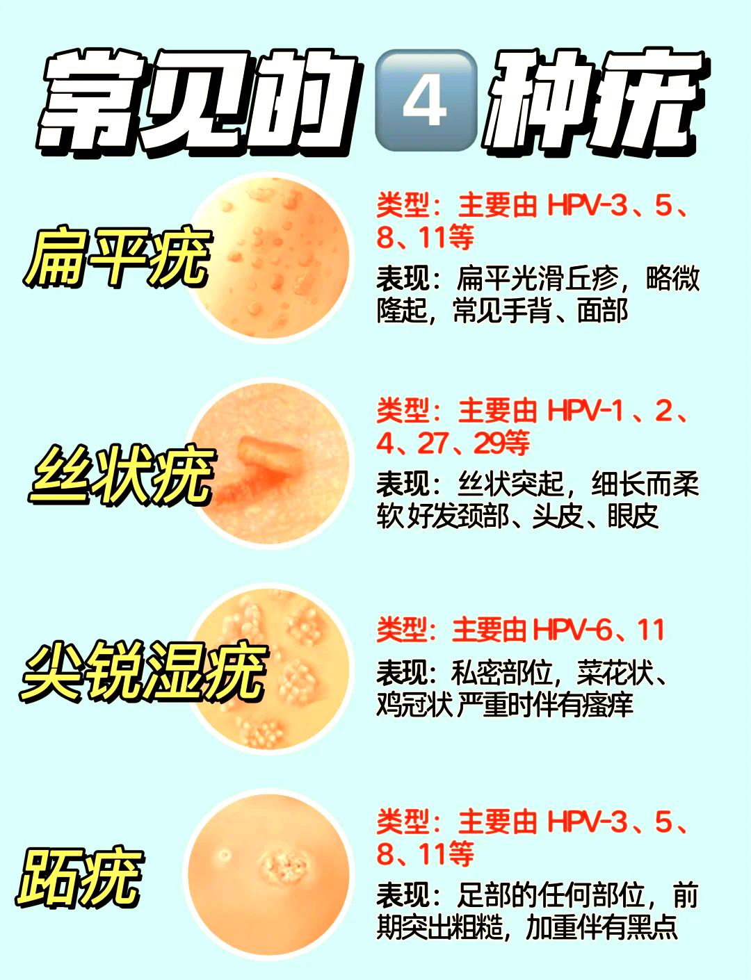 疣的种类及图片及治疗方法(私处疣的种类及图片及治疗方法) 疣的种类及图片及治疗方法(私处疣的种类及图片及治疗方法)