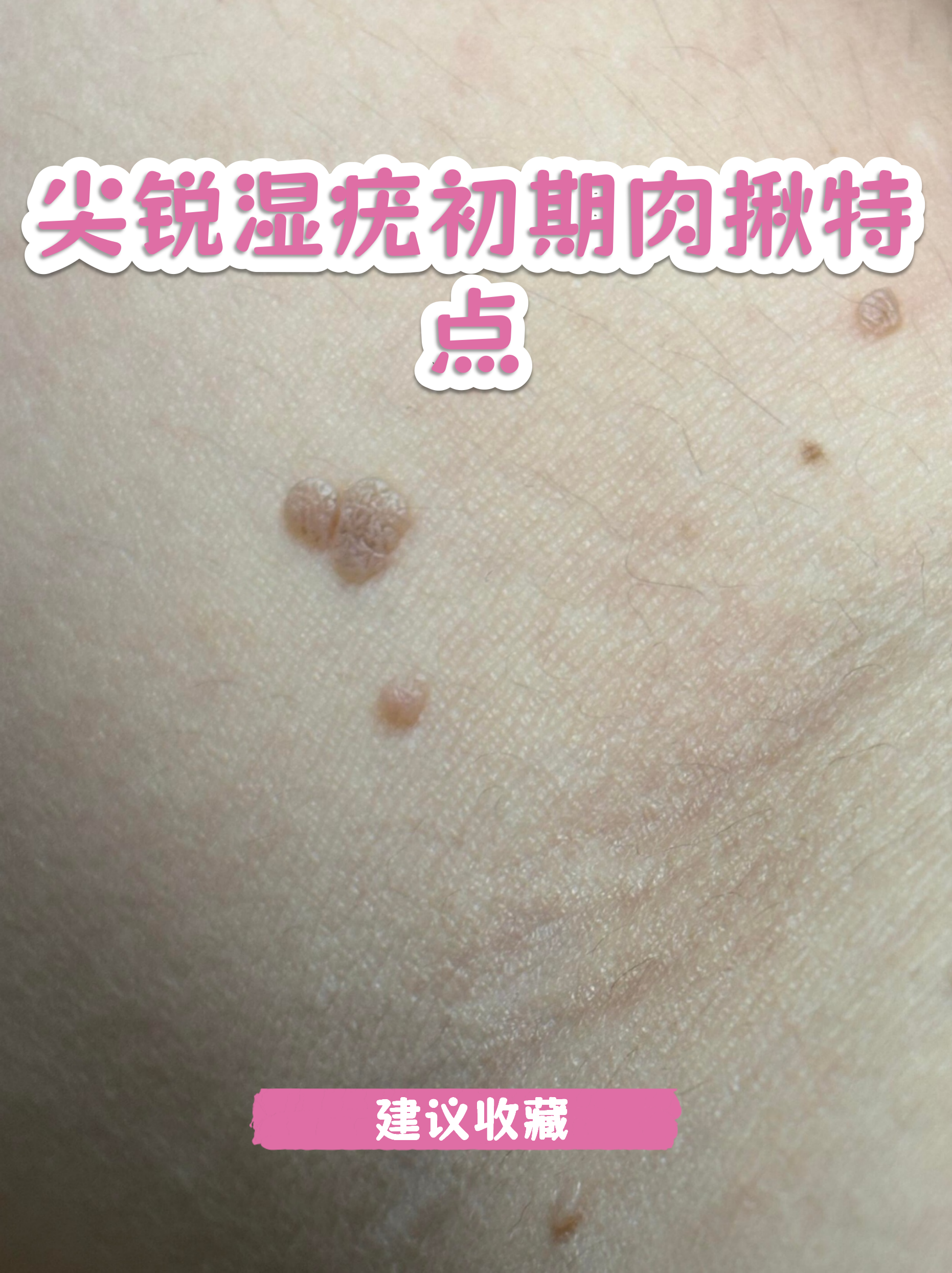 假性尖锐疣息肉图片(息肉状假性疣可消除吗)