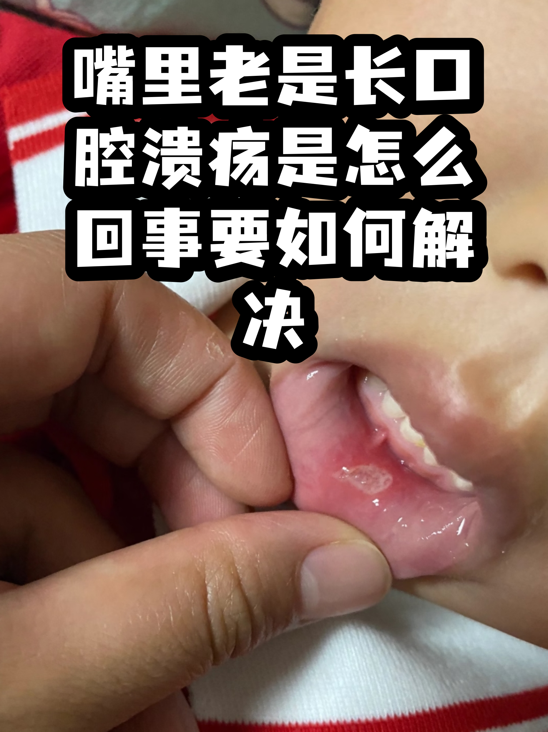 口腔溃疡发病原因图片(口腔溃疡发病原因 知乎)