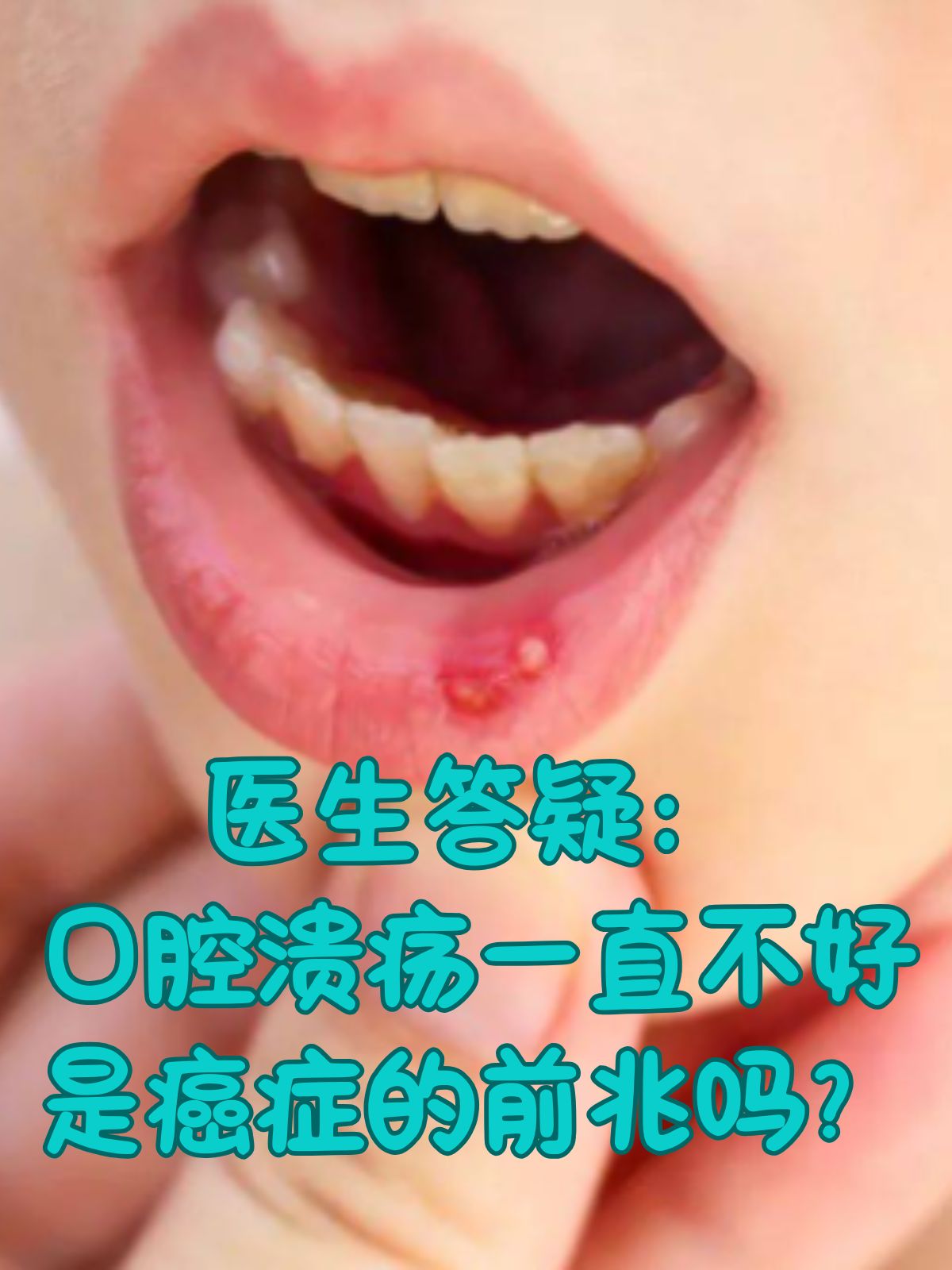 口腔溃疡发病原因图片(口腔溃疡发病原因 知乎) 口腔溃疡发病原因图片(口腔溃疡发病原因 知乎)