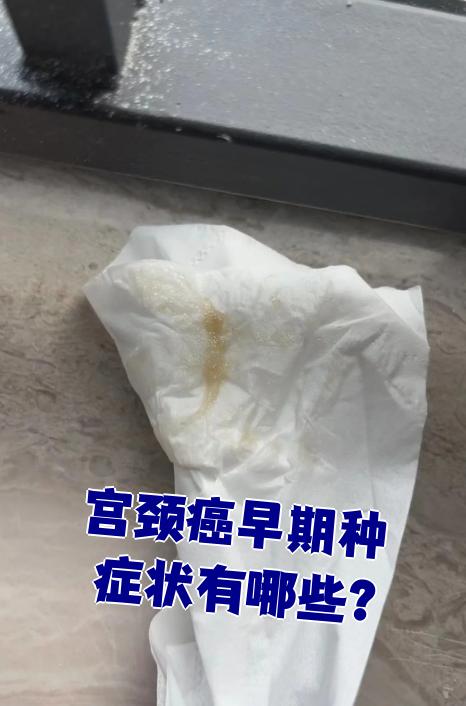 宫颈癌图片早期(宫颈癌图片是什么样) 宫颈癌图片早期(宫颈癌图片是什么样)