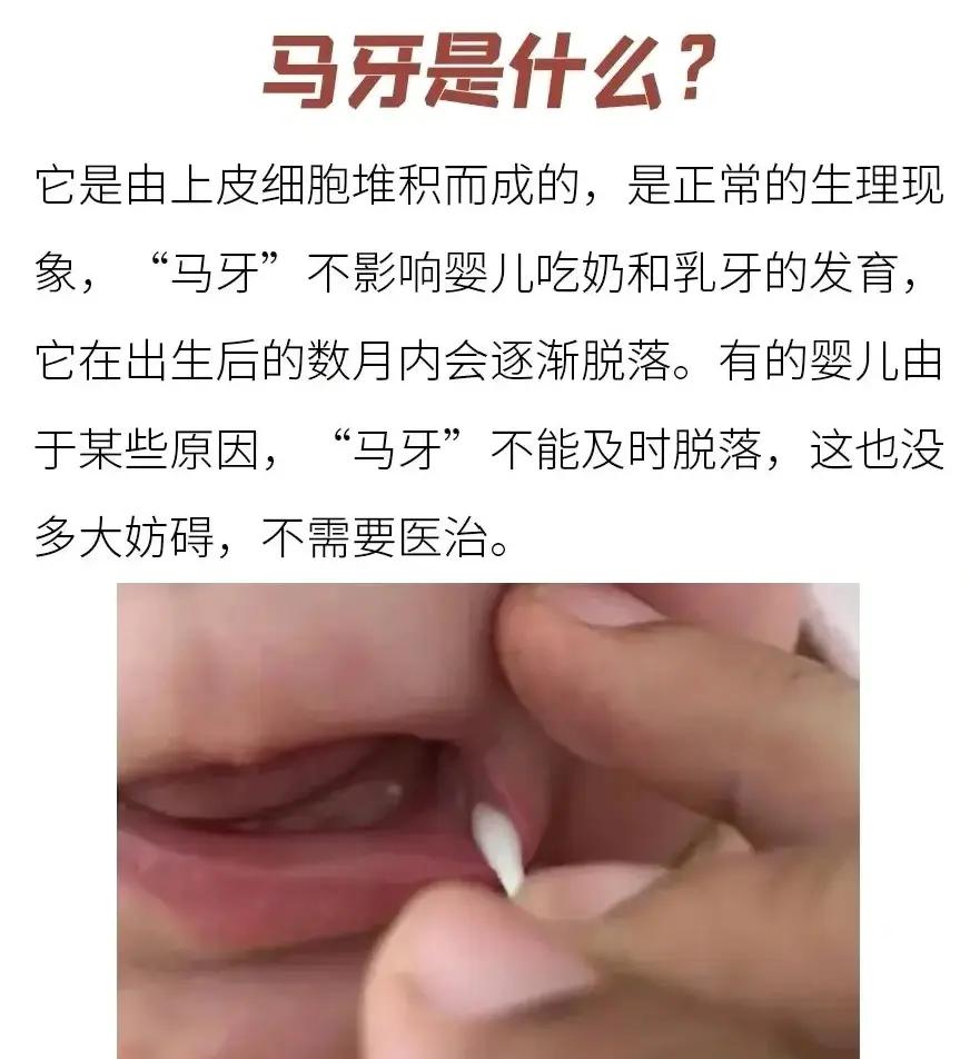 新生儿马牙图片大全(鹅口疮和马牙的辨别图) 新生儿马牙图片大全(鹅口疮和马牙的辨别图)