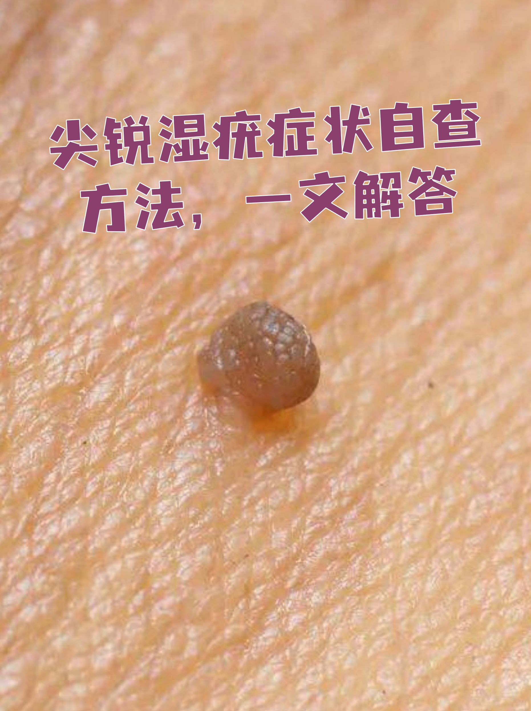 疣女性症状图片(女性疣的图片及名称)