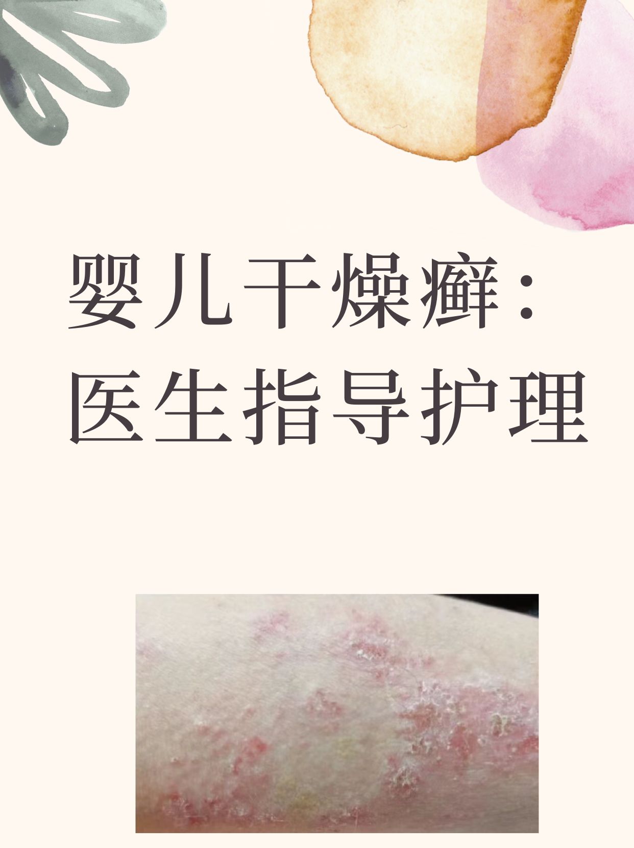 婴儿身上长干燥癣图片(婴儿身上长干燥癣图片和症状) 婴儿身上长干燥癣图片(婴儿身上长干燥癣图片和症状)