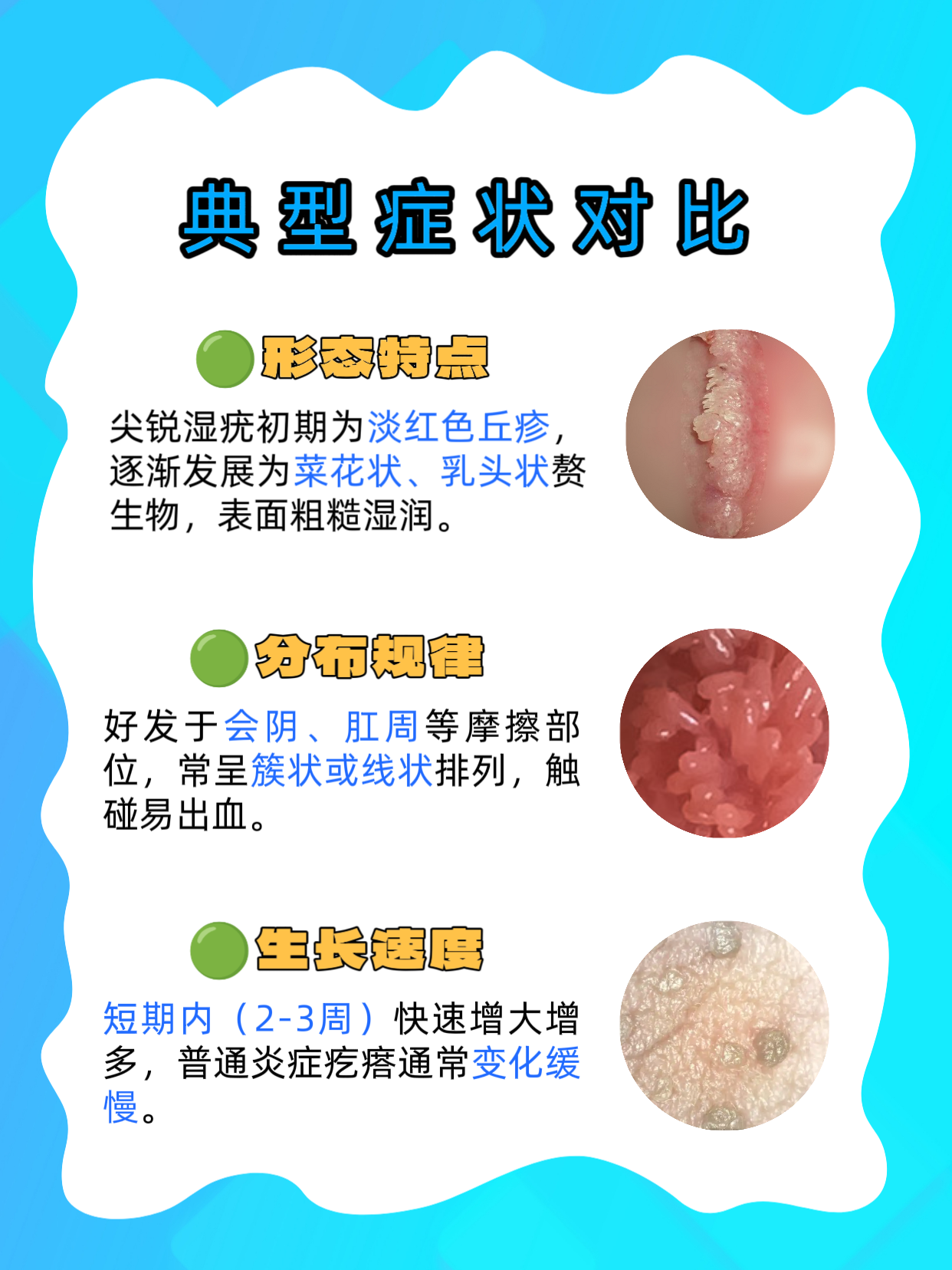 假性湿庞早期图片区别(假性湿庞会发展成真的吗) 假性湿庞早期图片区别(假性湿庞会发展成真的吗)