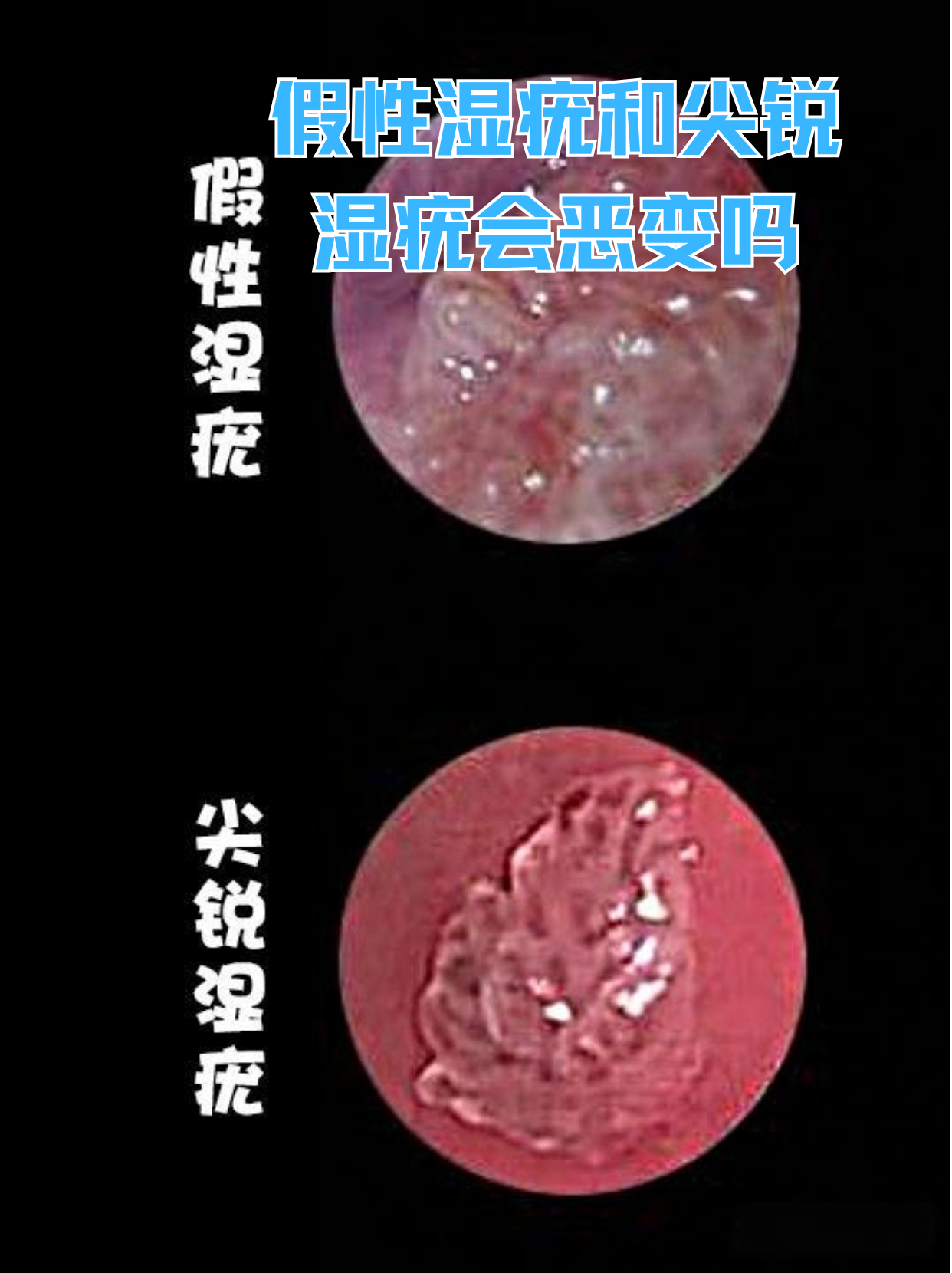 假性湿庞早期图片区别(假性湿庞会发展成真的吗) 假性湿庞早期图片区别(假性湿庞会发展成真的吗)