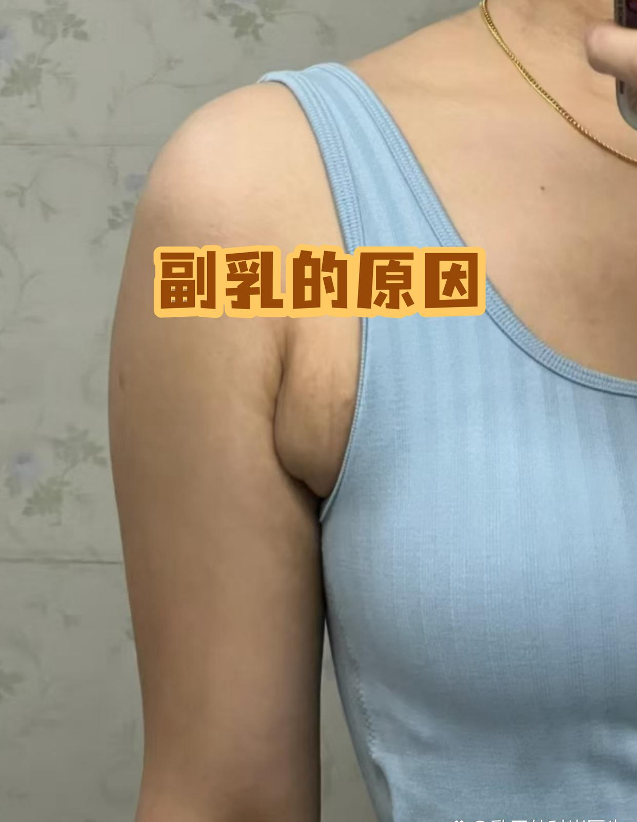 腋窝副乳什么样子(腋窝副乳长什么样子) 腋窝副乳什么样子(腋窝副乳长什么样子)