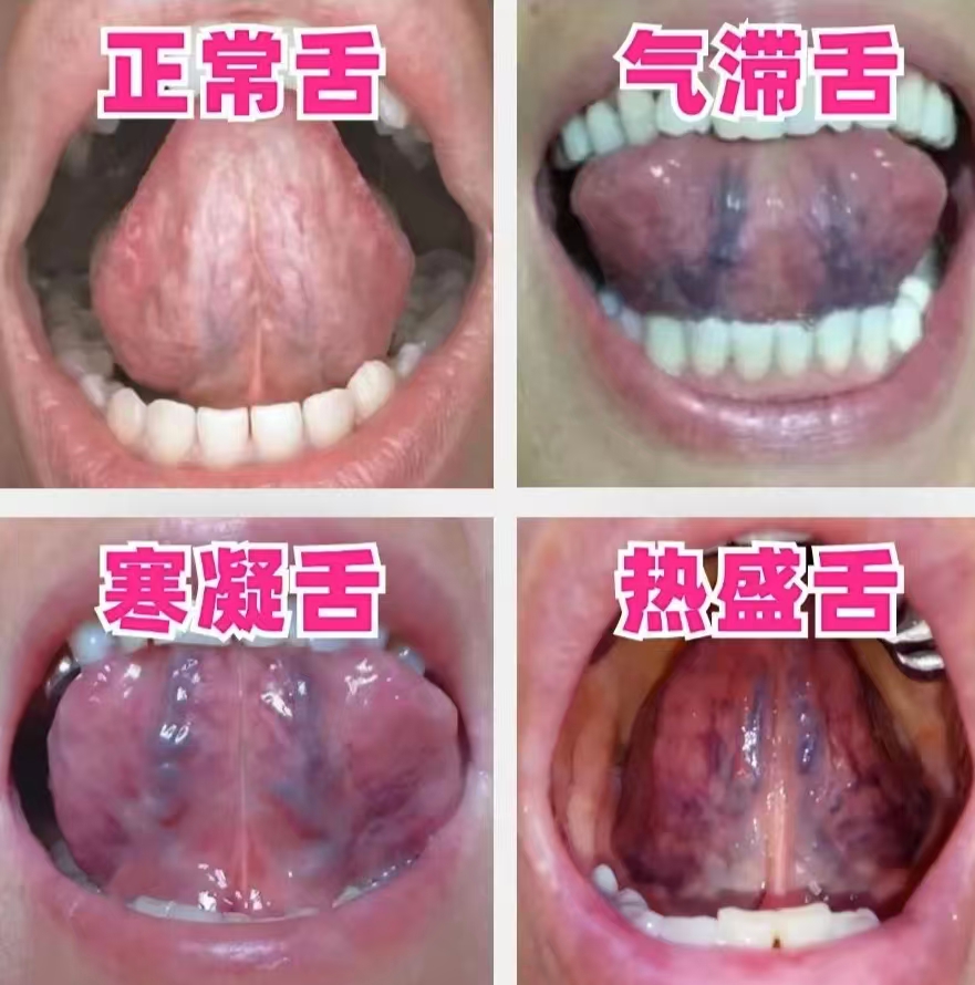 正常舌底部高清图片(口部感染hpv的症状) 正常舌底部高清图片(口部感染hpv的症状)