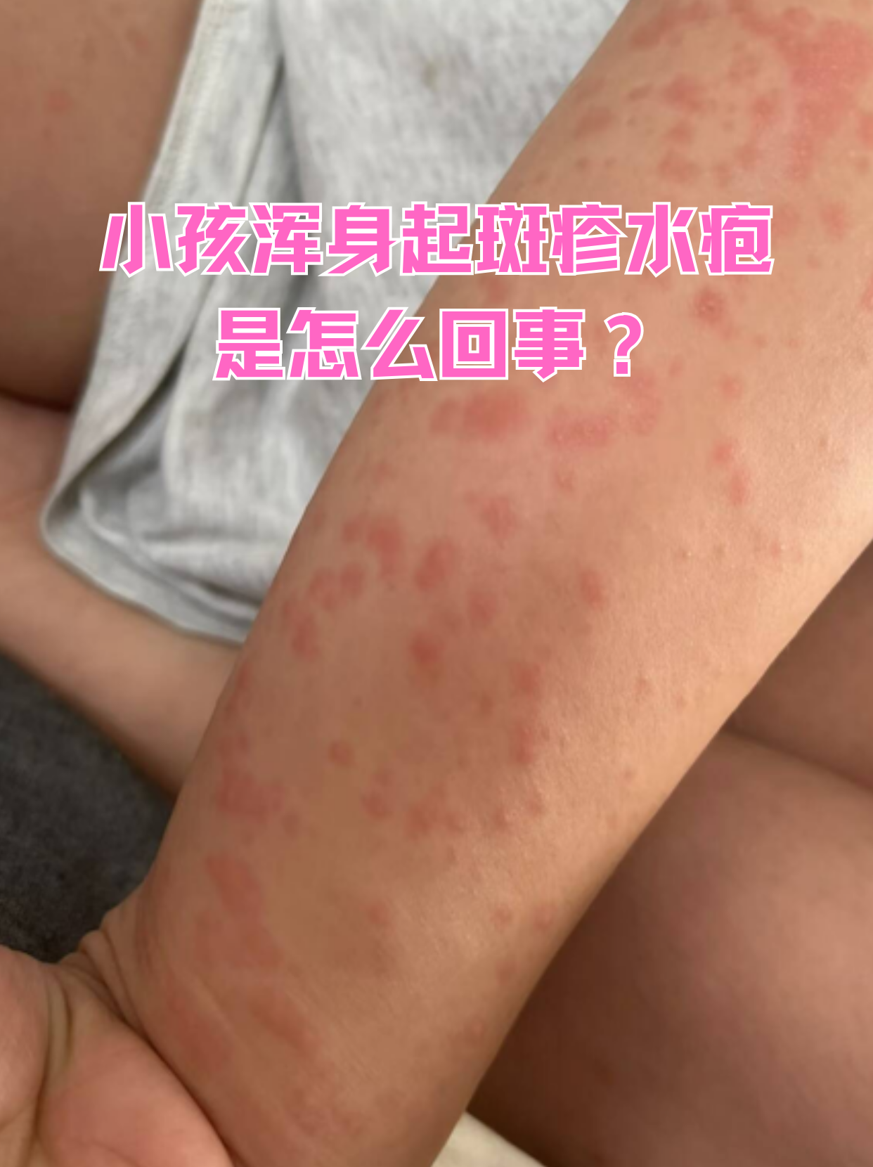 小儿水痘的症状和图片(小儿水痘的症状和图片大全) 小儿水痘的症状和图片(小儿水痘的症状和图片大全)