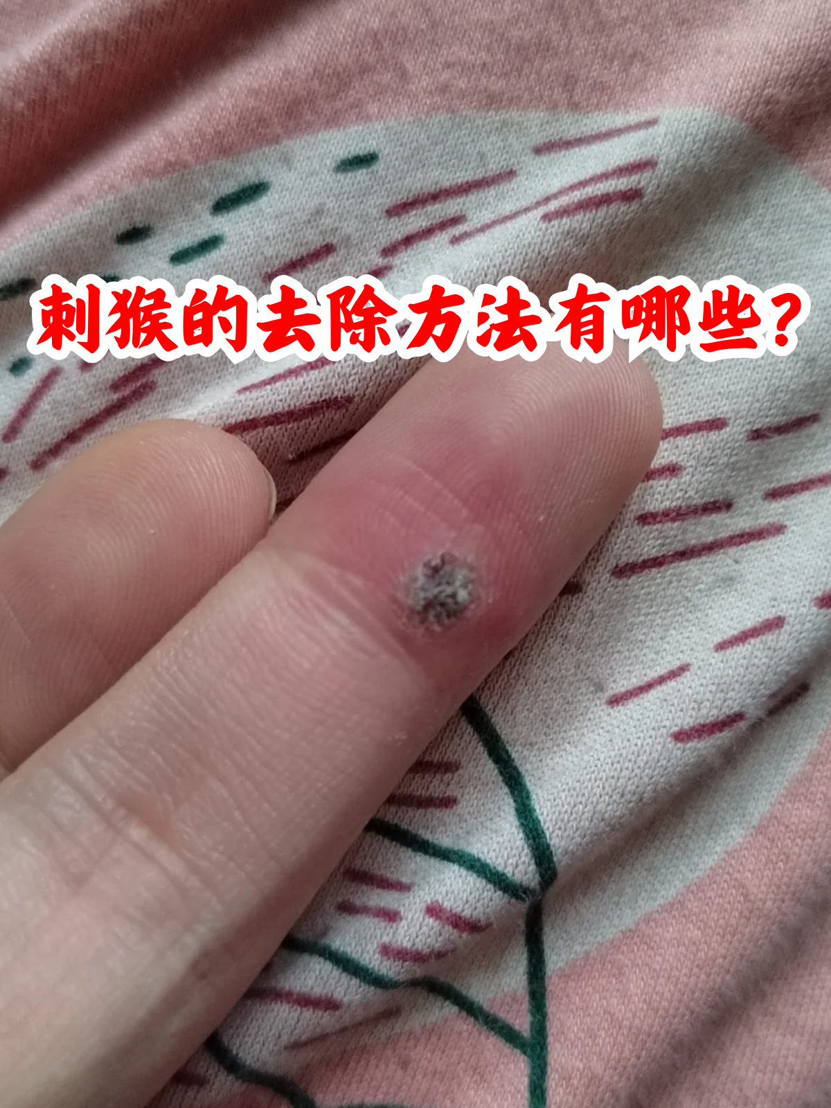 手部疣图片(手部疣是什么原因造成的) 手部疣图片(手部疣是什么原因造成的)