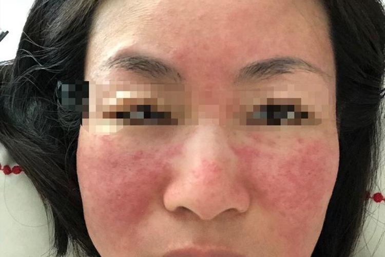玫瑰痤疮早期图片(玫瑰痤疮早期图片脸部) 玫瑰痤疮早期图片(玫瑰痤疮早期图片脸部)
