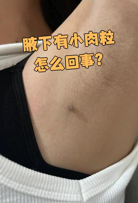 肉赘图片(大腿内侧肉赘图片) 肉赘图片(大腿内侧肉赘图片)
