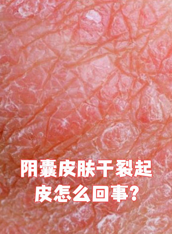 阴囊潮湿的图片(阴囊潮湿图片和症状图片) 阴囊潮湿的图片(阴囊潮湿图片和症状图片)
